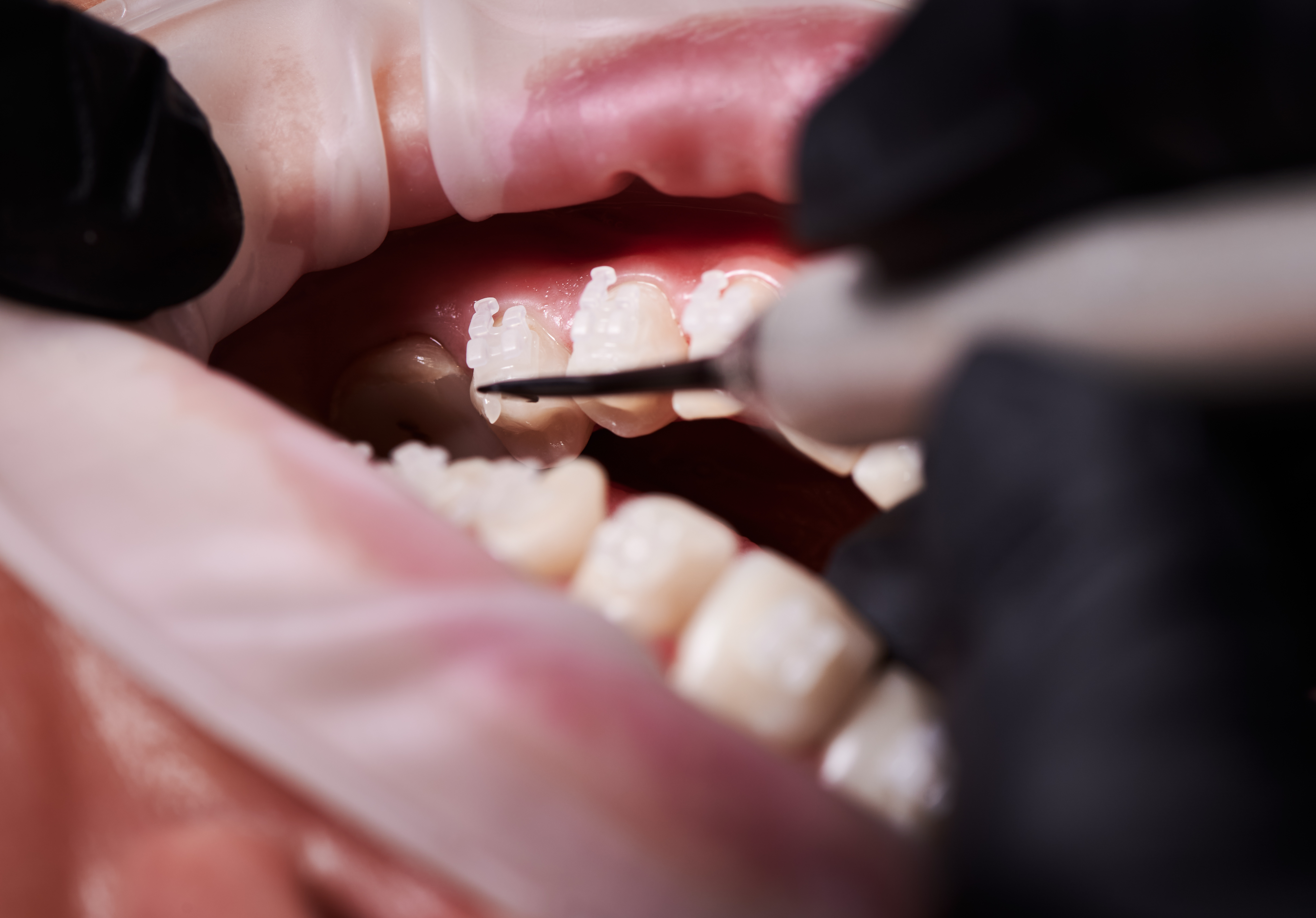 Dentist attaching white braces to patient teeth