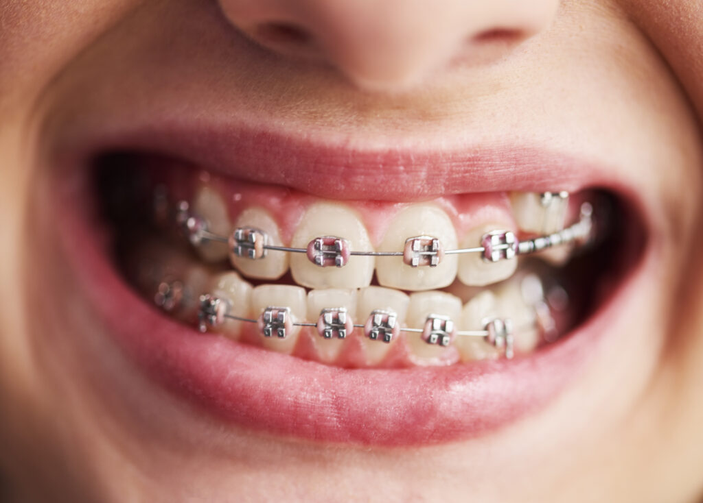 Shot of child's teeth with braces
